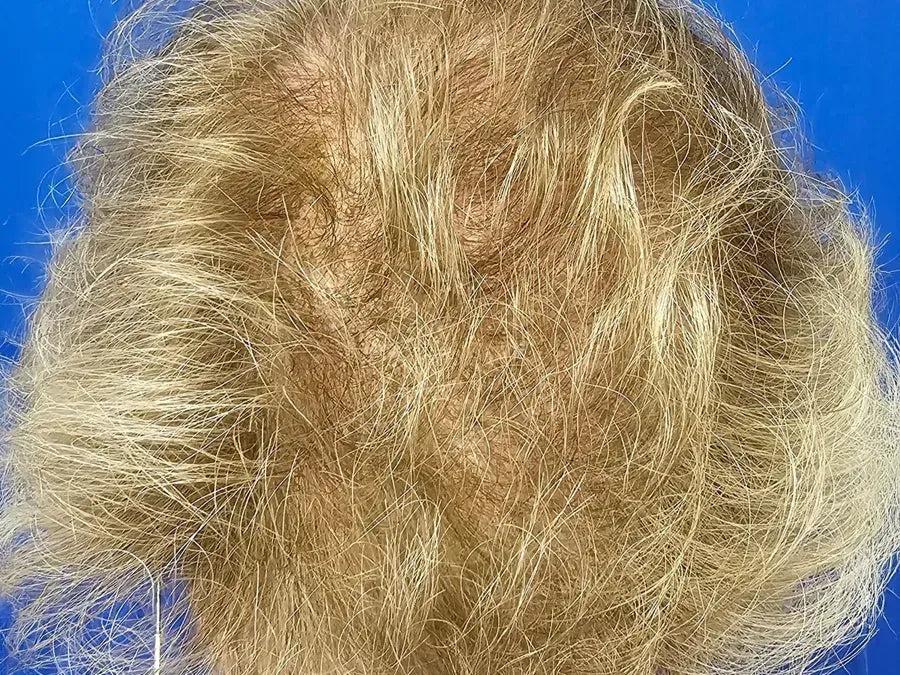Follow-up hair appearance
