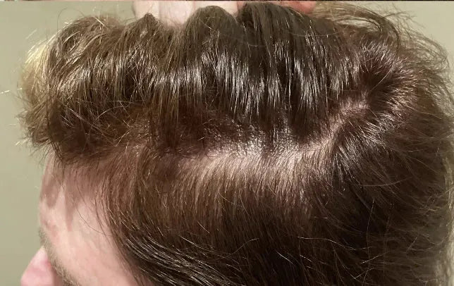 Follow-up hair appearance