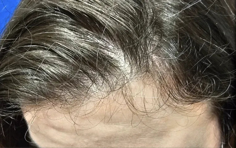 Follow-up hair appearance